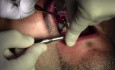 Sterowana regeneracja kości - Legacy-Implant Direct, Mineross