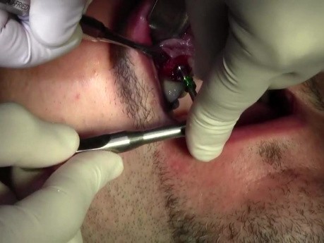Sterowana regeneracja kości - Legacy-Implant Direct, Mineross