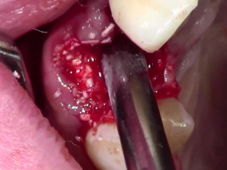 Ekstrakcja zęba z prostym przeszczepem kostnym