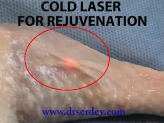 Zimny laser na odmłodzenie skóry