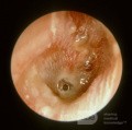 Ostre zapalenie ucha środkowego z umieszczoną rurką wentylacyjną (AOMT)