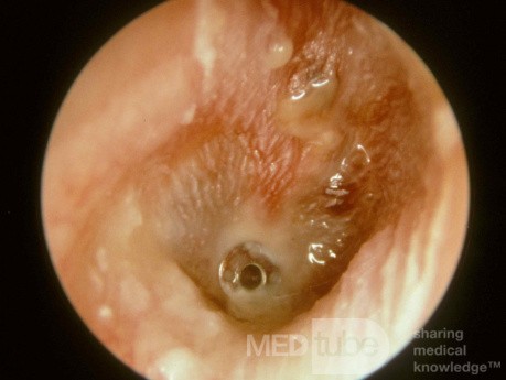 Ostre zapalenie ucha środkowego z umieszczoną rurką wentylacyjną (AOMT)