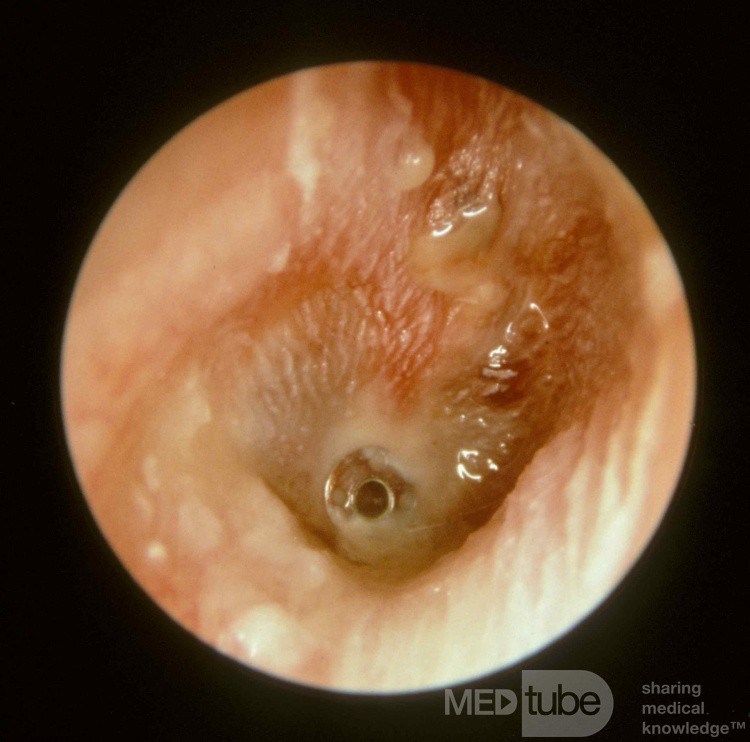 Ostre zapalenie ucha środkowego z umieszczoną rurką wentylacyjną (AOMT)