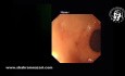 Endoscopie dans un Cas de Torsion Gastrique après Gastrectomie Sleeve