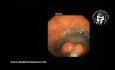 Endoskopowa resekcja błony śluzowej (EMR) w leczeniu dużych polipów odbytnicy