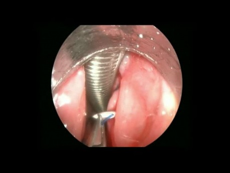 Endoskopowa lateralizacja strun głosowych