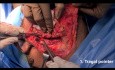 3 chirurgiczne punkty orientacyjne w identyfikacji nerwu twarzowego podczas usuwania ślinianki przyusznej