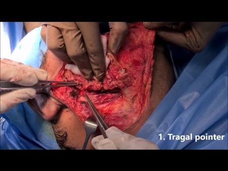 3 chirurgiczne punkty orientacyjne w identyfikacji nerwu twarzowego podczas usuwania ślinianki przyusznej