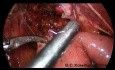 Laparoskopowa hepatojejunostomia