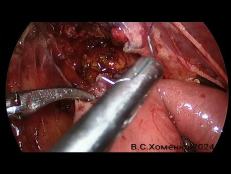 Laparoskopowa hepatojejunostomia