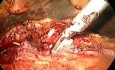 Pankreatoduodenektomia - metoda Whipple'a - część 2/3