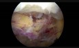 Usunięcie przepukliny krążka międzykręgowego (discektomia) w stenozie kręgosłupa lędźwiowego z dostępu przeciwstronnego