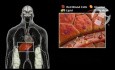 Hiperlipidemia