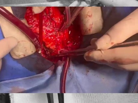 Homograft płucny od dawcy po zatrzymaniu krążenia (DCD) do rekonstrukcji drogi odpływu prawej komory (RVOT)