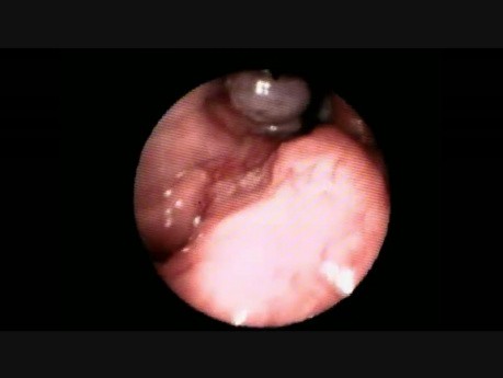 Obraz endoskopowy guza nosogardła