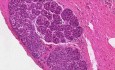 Rak zrazikowy in situ - histopatologia - pierś