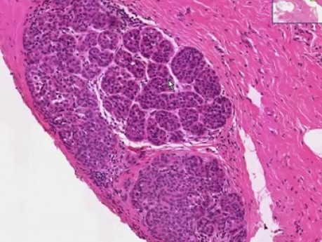 Rak zrazikowy in situ - histopatologia - pierś