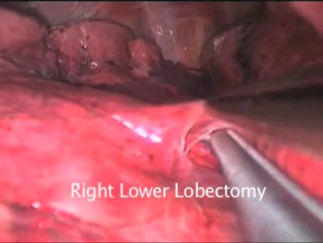 Wideotorakoskopowa lobektomia z powodu raka płuca, przeprowadzona przez jeden port.