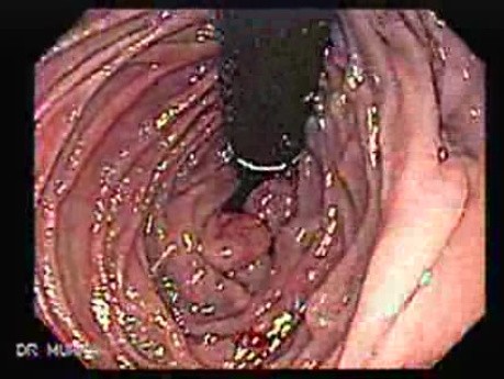 Chłoniak żołądka z przerzutami do dwunastnicy - ocena dwunastnicy w inwersji endoskopowej, część 2