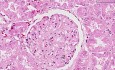 Toczeń rumieniowaty układowy - histopatologia - nerka