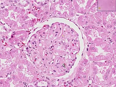 Toczeń rumieniowaty układowy - histopatologia - nerka