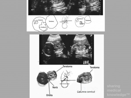 Potworniak szyi u płodu - diagnostyka prenatalna USG