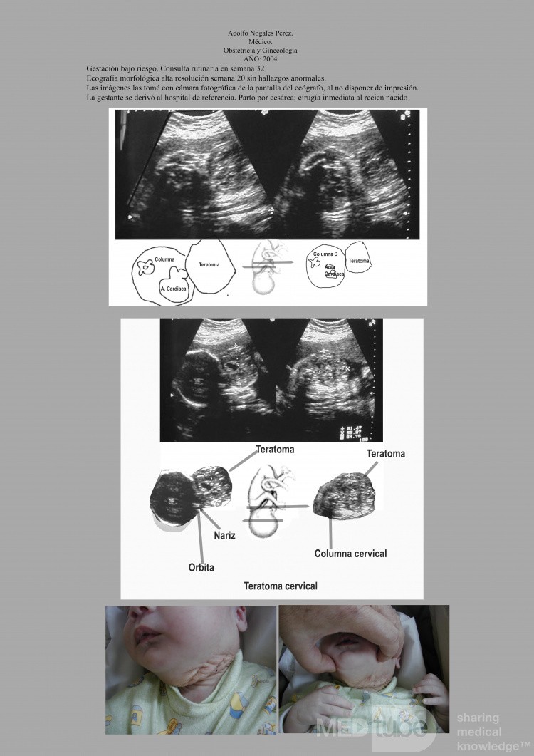 Potworniak szyi u płodu - diagnostyka prenatalna USG