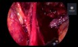 Endometrioza głęboko naciekająca tylnego przedziału - resekcja en bloc