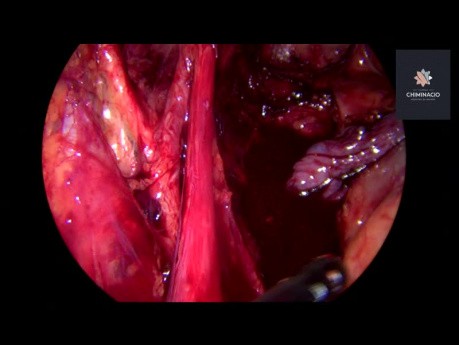 Endometrioza głęboko naciekająca tylnego przedziału - resekcja en bloc