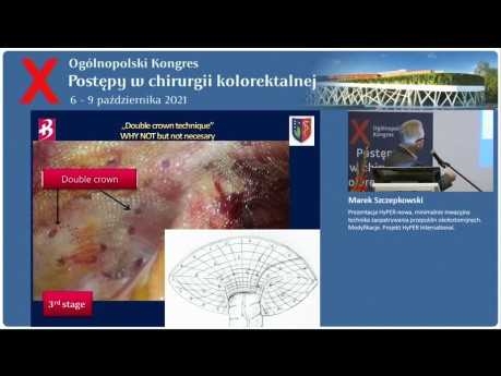 Prezentacja HyPER-nowa, minimalnie inwazyjna technika zaopatrywania przepuklin okołostomijnych