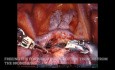 Robotowa górna lobektomia płuca prawego