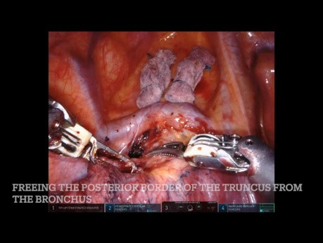 Robotowa górna lobektomia płuca prawego