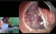 Endoskopowa dyssekcja podśluzówkowa (ESD) gruczolaka odbytnicy - dr Makot Nishimura