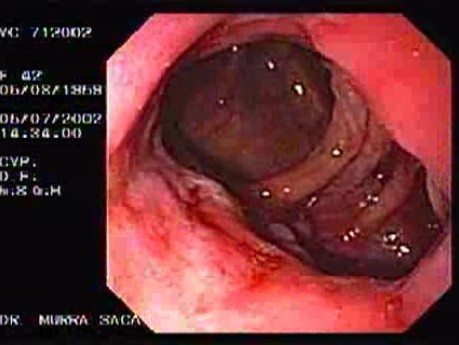 Choroba Leśniowskiego - Crohna - endoskopia (23 z 28)