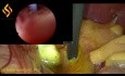 Cholecystektomia laparoskopowa i choledochotomia 