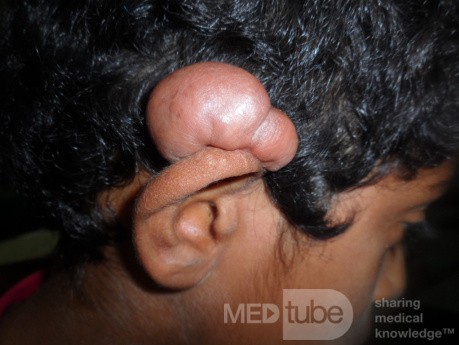 Keloid