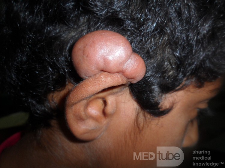 Keloid