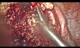 Laparoskopowe wycięcie dużego gruczolaka