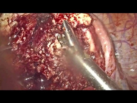 Laparoskopowe wycięcie dużego gruczolaka