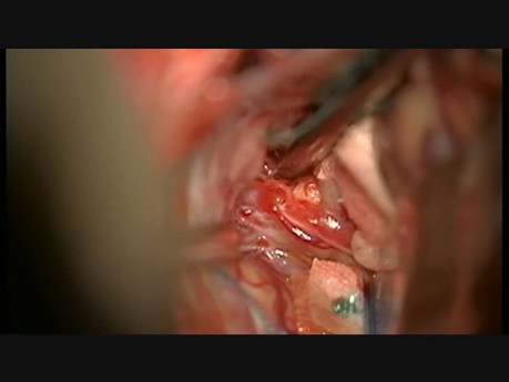 Klipsowanie tętniaka na tętnicy okołospoidłowej z dostępu międzypółkulowego czołowego