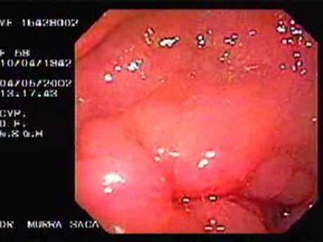 Gruczolakorak jamy żołądka - endoskopia (1 z 2)