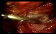 Hernioplastyka laparoskopowa metodą TEP bez użycia elektrokoagulacji