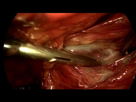 Hernioplastyka laparoskopowa metodą TEP bez użycia elektrokoagulacji