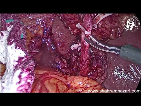 Cholecystektomia laparoskopowa krok po kroku 