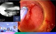ERCP Gastroskopem