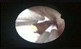Usunięcie mięśniaka w trakcie resektoskopii