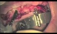 Implantacja w systemie All-on-4 - szczęka