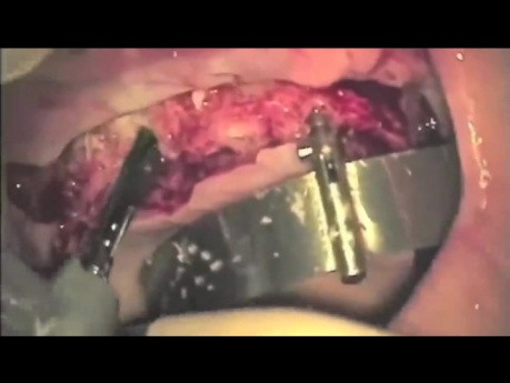 Implantacja w systemie All-on-4 - szczęka