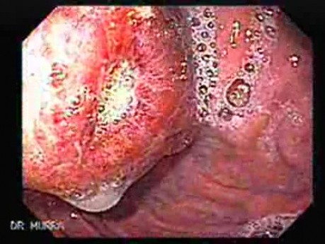 Żylaki żołądka - endoskopowa ablacja klejem cyjanoakrylowym (14 z 18)