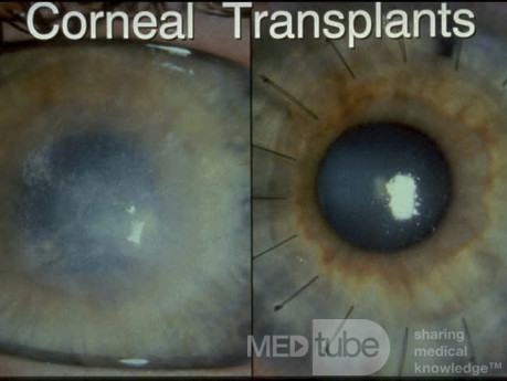 Przed i po transplantacji rogówki
